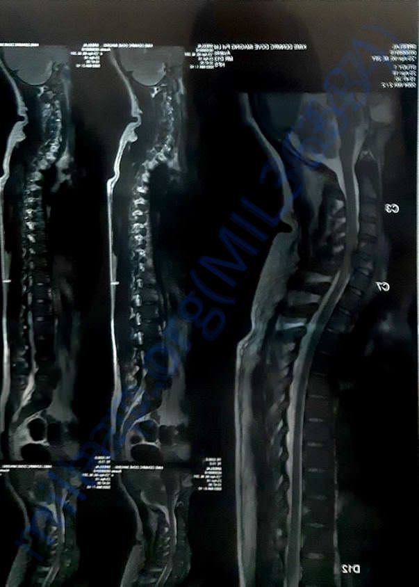 Spinal cord