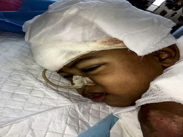 Fire Accident - This baby 50% of body deeply burnt below her chest. .