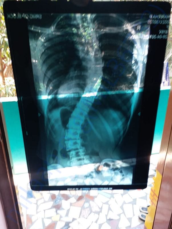 Scan image showing the S shaped spine