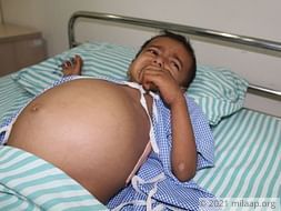 Baby's Stomach Has Swollen To The Size Of A Football Because Of Cancer