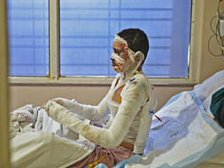 A Transformer Burst Has Left This 24-Year-Old Completely Burnt