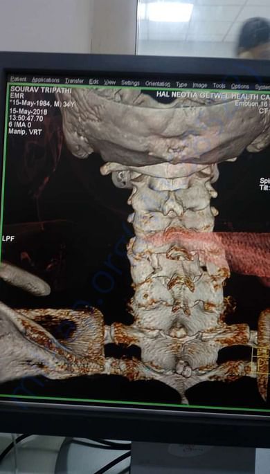 Spine injury