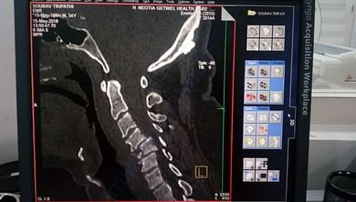 Spine damage condition