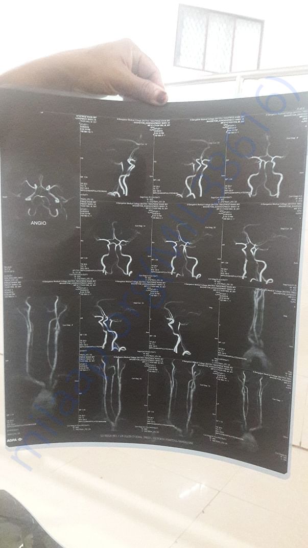 MRI Scan