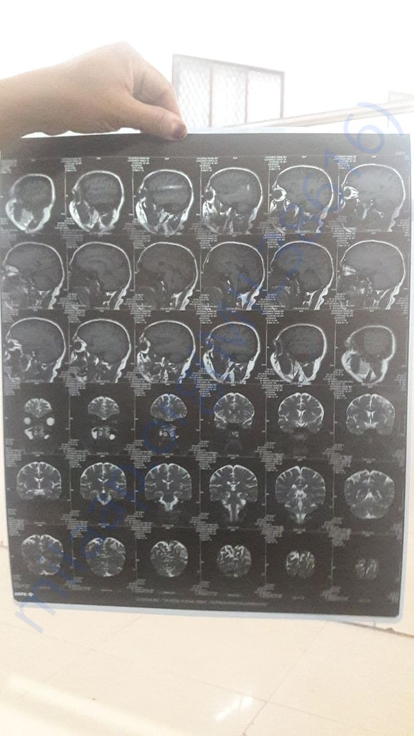 MRI Scan