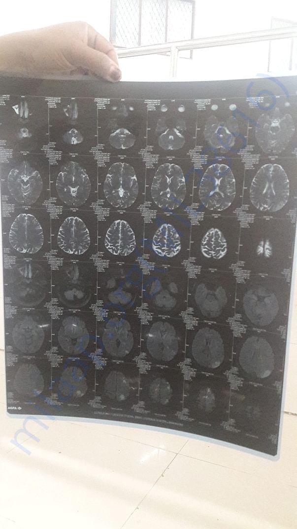 MRI Scan