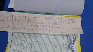 ECG
