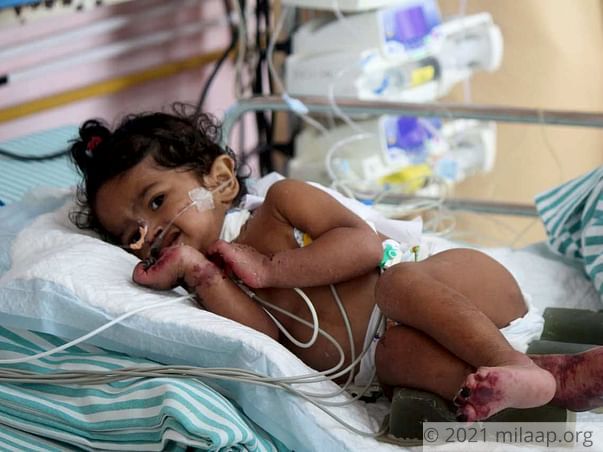 10-Month-Old Baby Girl Will Lose Her Limbs And Life To Gangrene