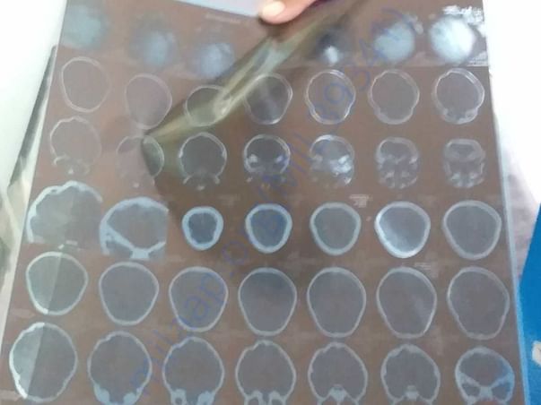 X ray