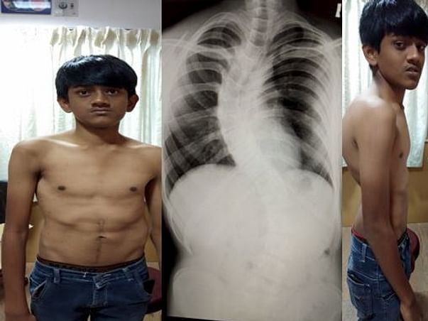 Help 18 Year Old Engineering Student Undergo Spinal Deformity Surgery