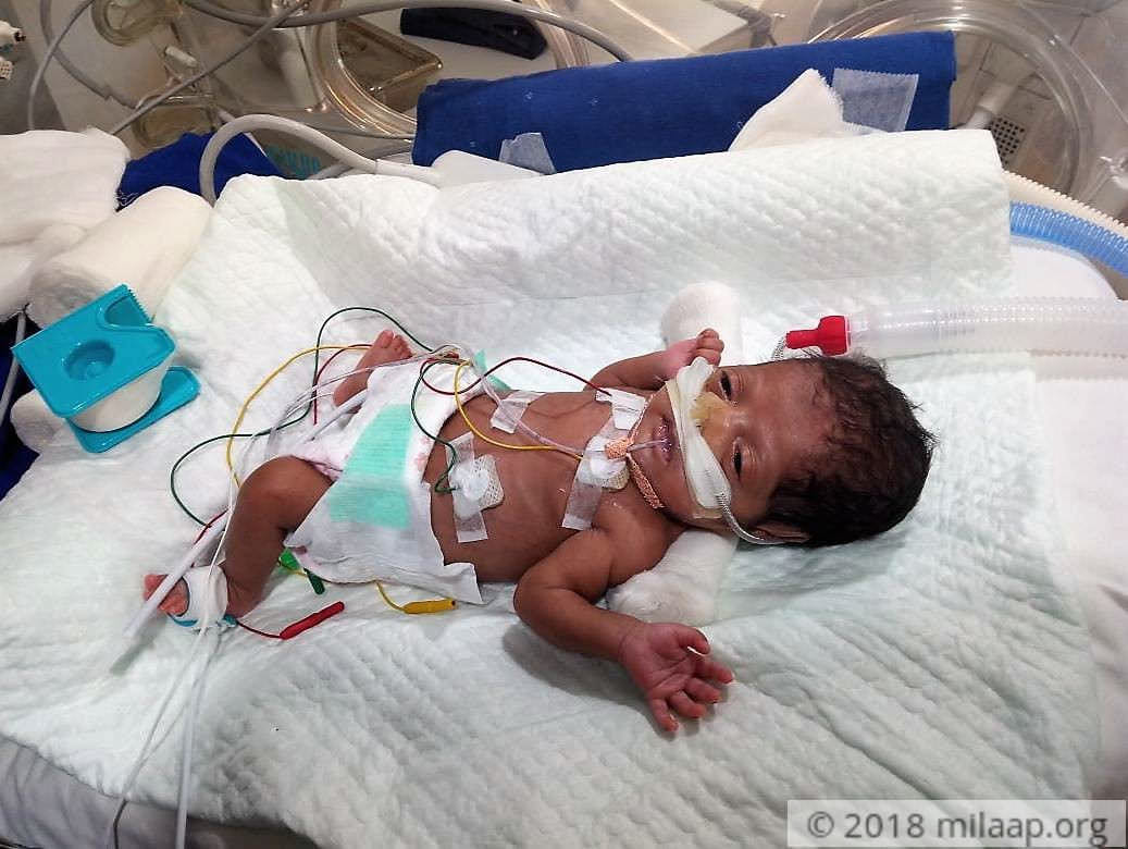 They Did Not Think She Would Survive But This 1 2kg Baby Girl Is A Fighter Milaap