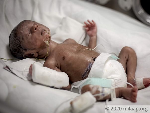 16-Day-Old Premature Baby Needs To Stay In The NICU To Survive