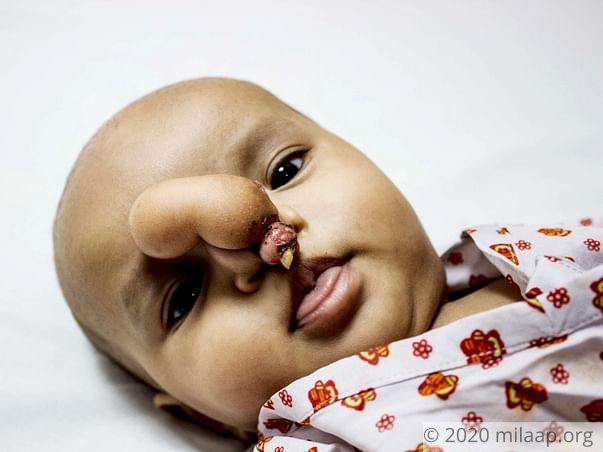 5-month-old Shanti has a rare condition which doesn't let her breathe