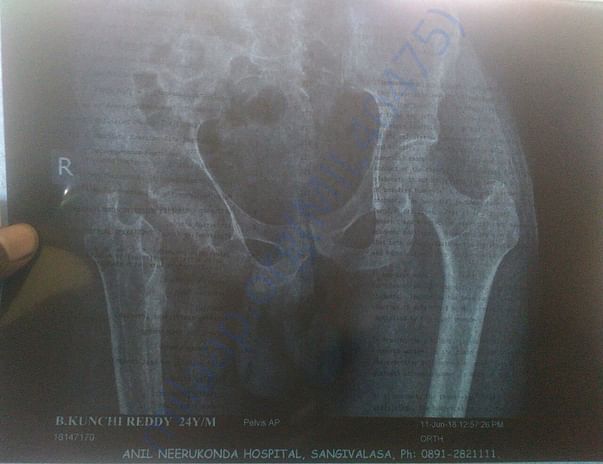 Scanner of hip joint failure