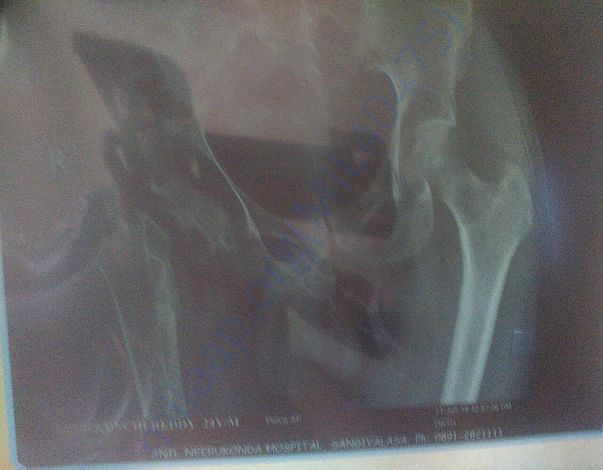 Hip joint failure
