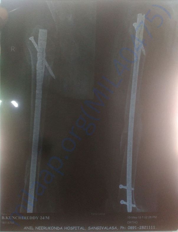 Scanner of knee joint