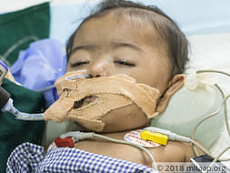 This 7-month-old cannot exhale on her own and needs urgent treatment