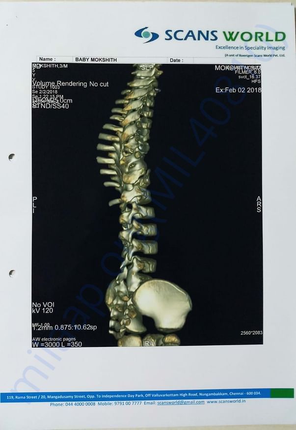 Twisted spine pic 1