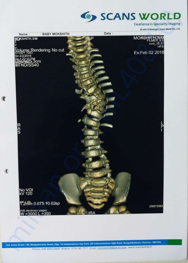 Twisted spine scan 2