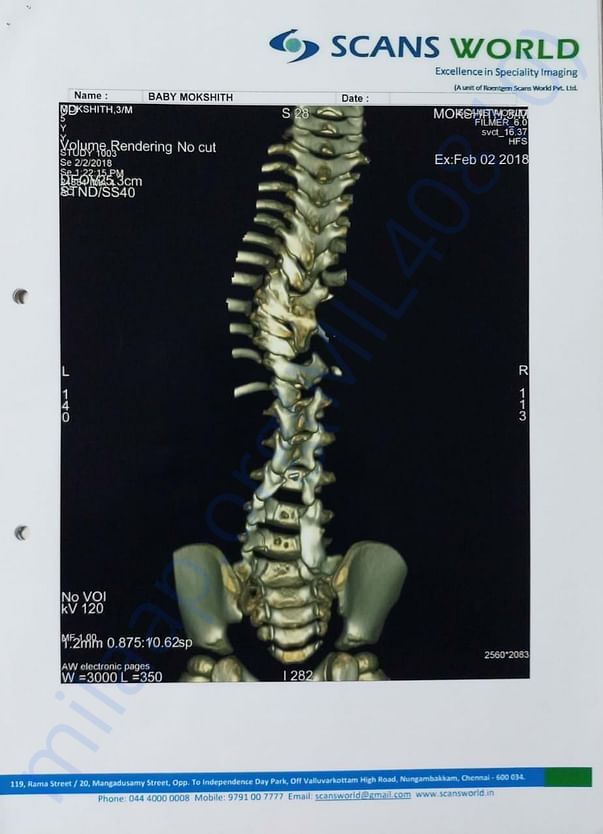 Twisted spine scan 3