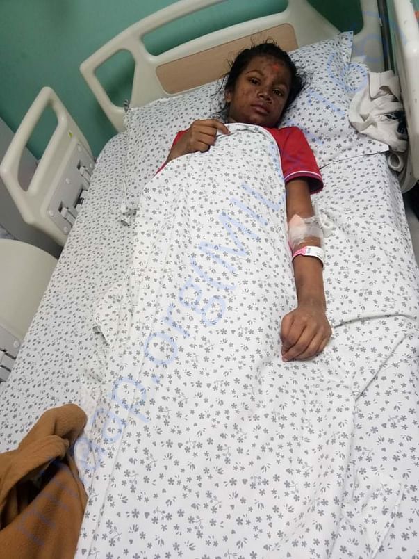 After lupus