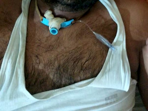 Help Sanjay Undergo Baloon Sinuplasty Treatment