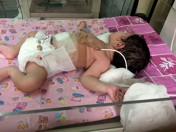Help Pooja's New Born Baby went through Intestinal Obstruction Surgery