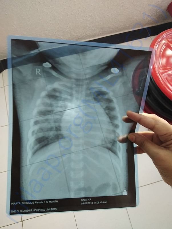 x-ray