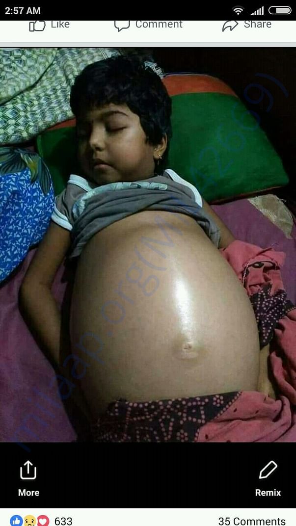 nephrotic syndrome