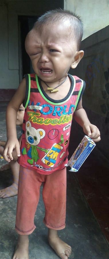 AICHUK HAVE TWO TUMOUR