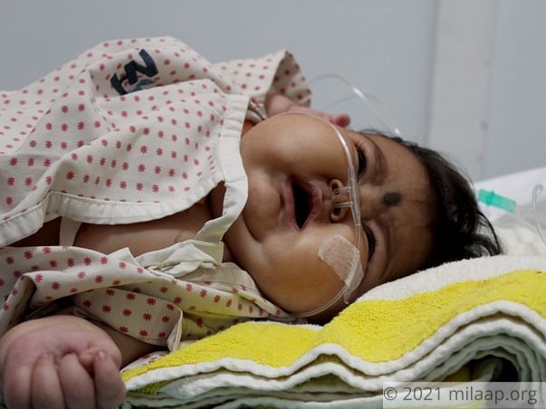 Help 5 months old Sanjana to get a Bone Marrow Transplant