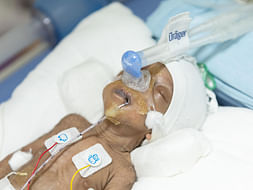 Severe Brain Infection Will Kill This 1-month-old Baby Girl