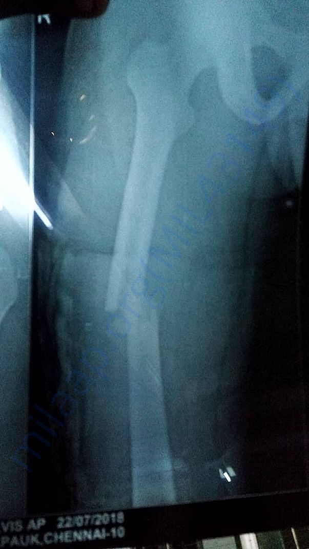 X-ray of the thigh