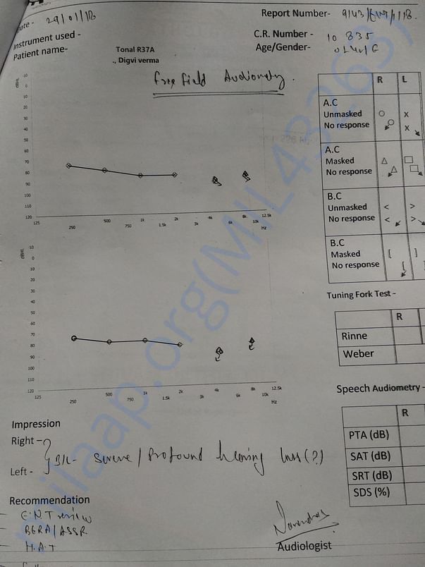 AIIMS report for cochlear implant for both ears
