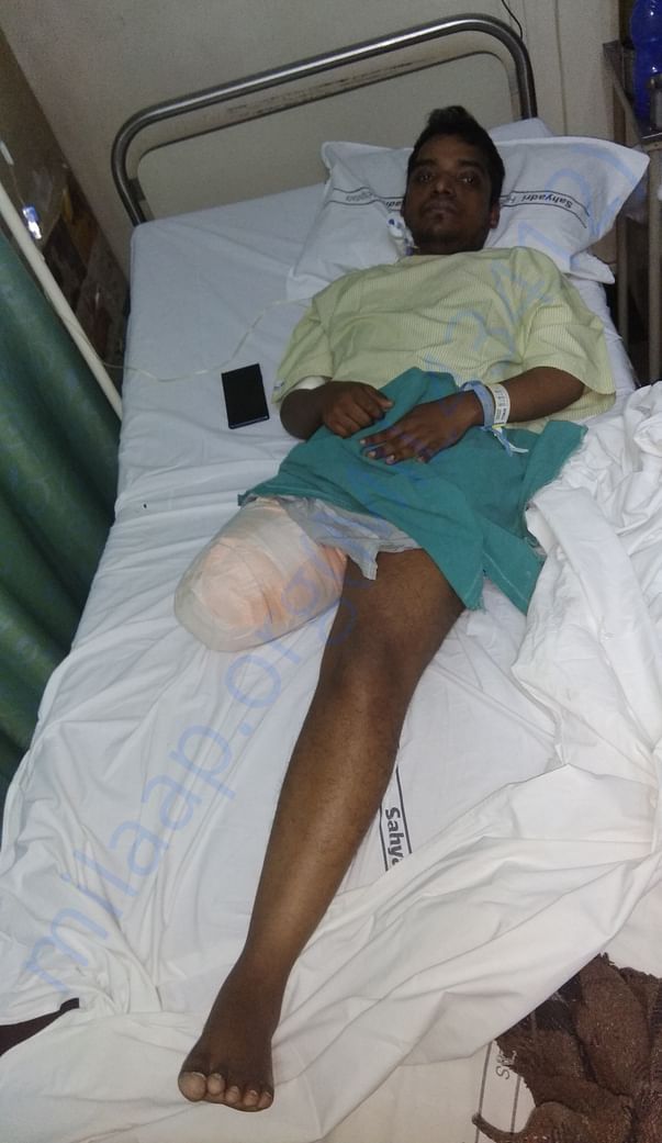 Vilas Right Leg amputation due to Hemophilia