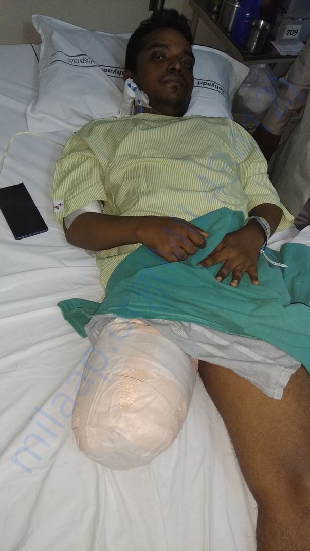Vilas Right leg amputation due to Hemophilia