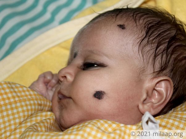 2-Month-Old Baby's Enlarged Liver Will Kill Her Without Urgent Help