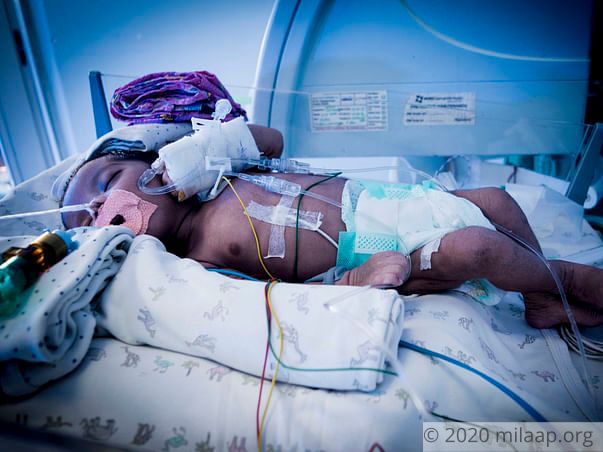 1-Month-Old Baby Who Struggles For Every Breath Needs Urgent Help