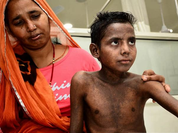 14-year-old with painful boils all over body needs urgent transplant