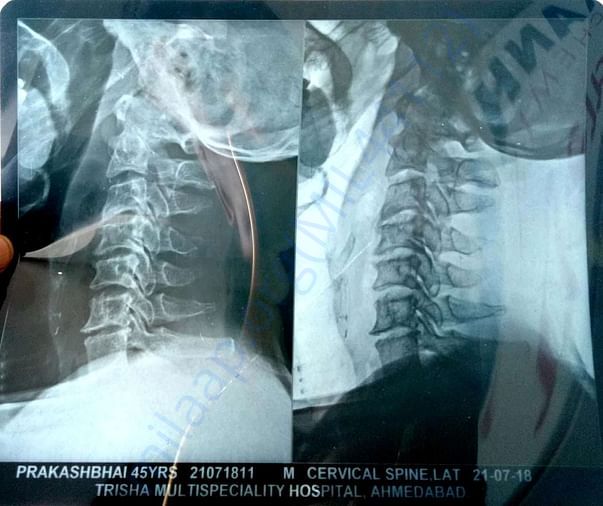 X rays