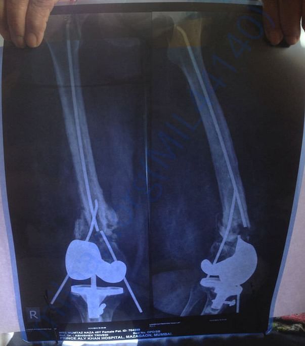 X-ray in November 2014