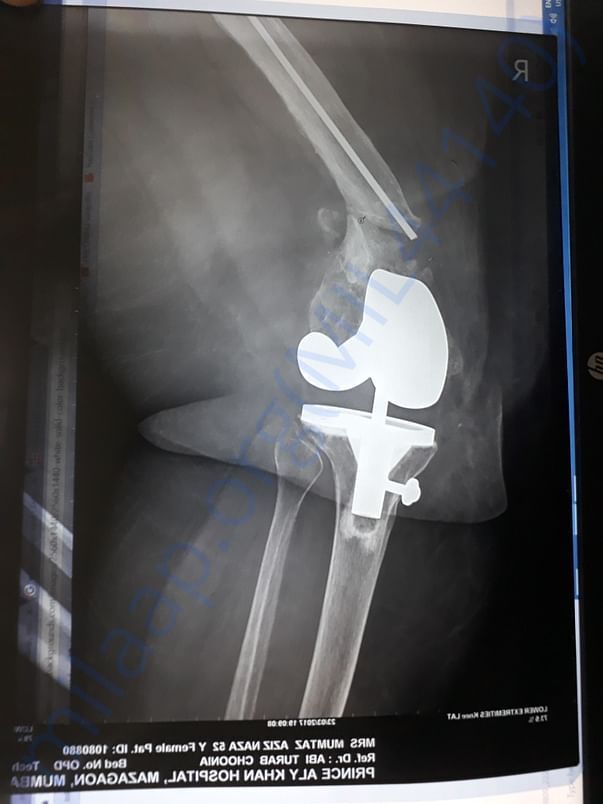 X-ray in March 2017