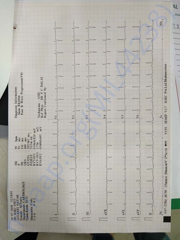 ECG