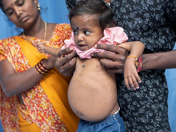 If Baby Lokesh does not get a new liver soon, he may not survive