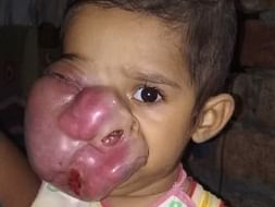 Help Baby Rohan Fight Against Deadly Rhabdomyosarcoma