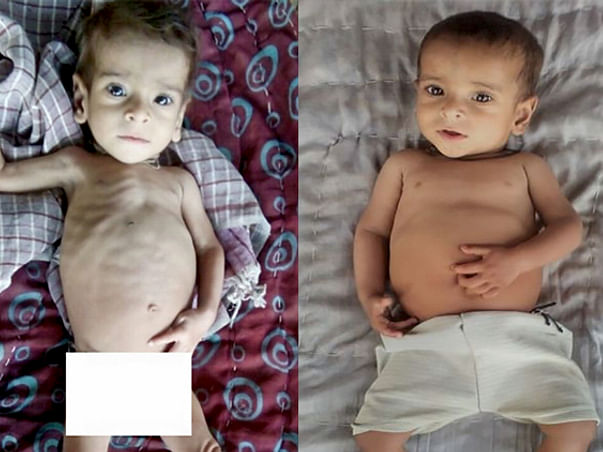 You can save lives of 500 malnourished children in Rajasthan!