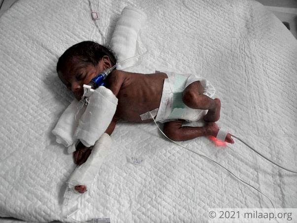 Extremely Premature Twins Fighting Multiple Illnesses Need Urgent Help