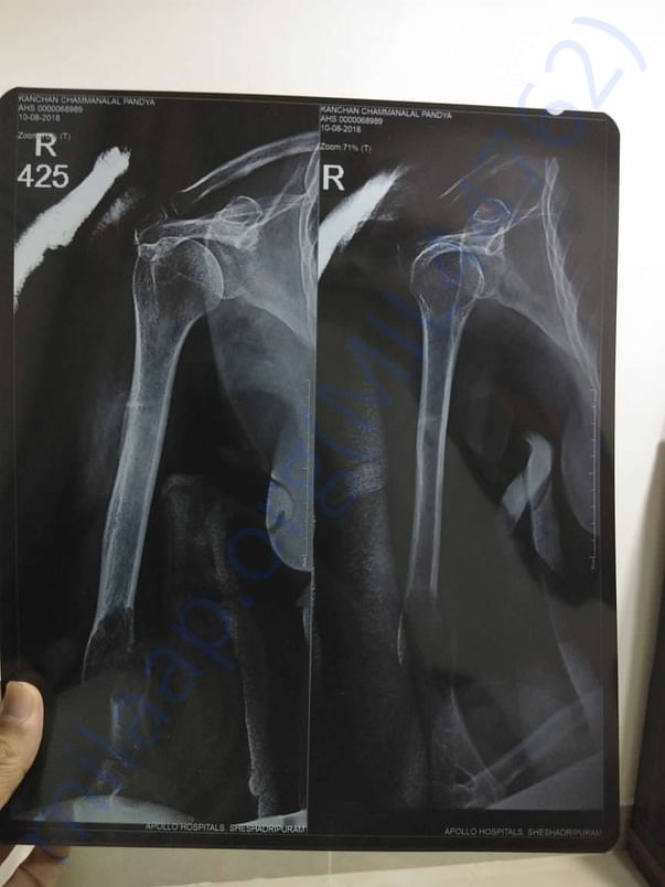 Right hand fractured sca