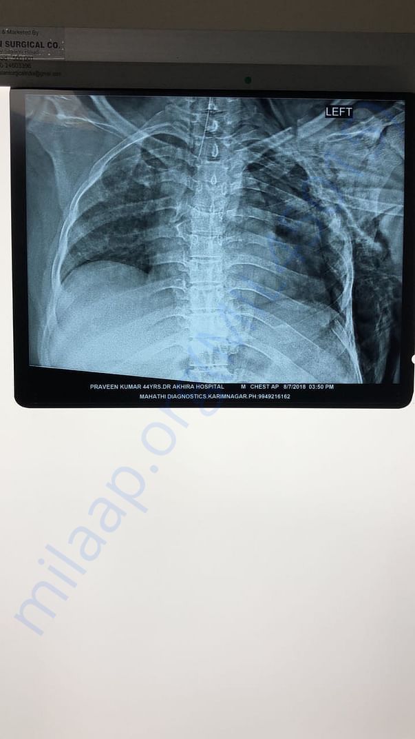 Chest X-ray