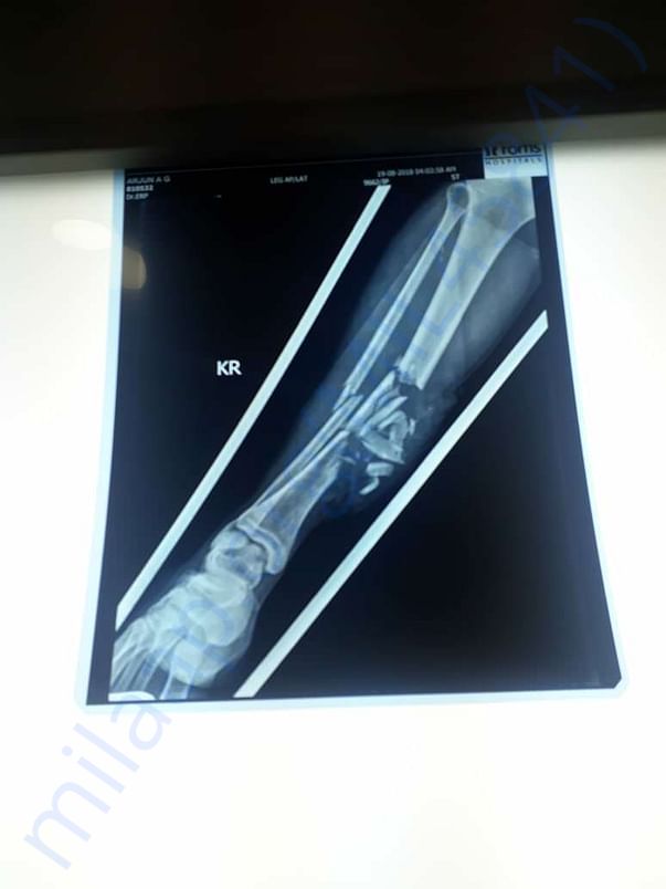 Xray5